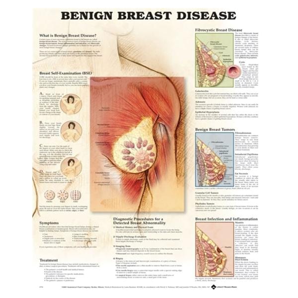 Benign Breast Disease 20x26" Anatomical Chart Ea