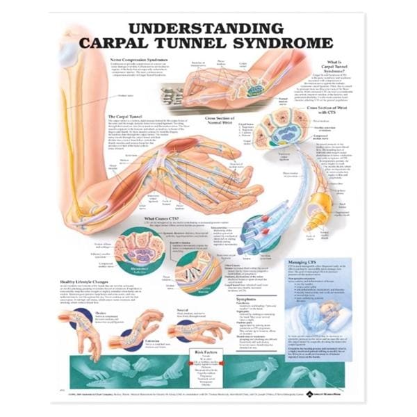 Carpel Tunnel Syndrome 20x26" Anatomical Chart Ea