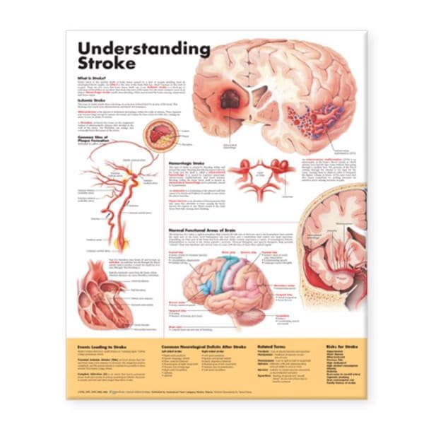 Stroke 20x26" Anatomical Chart Ea