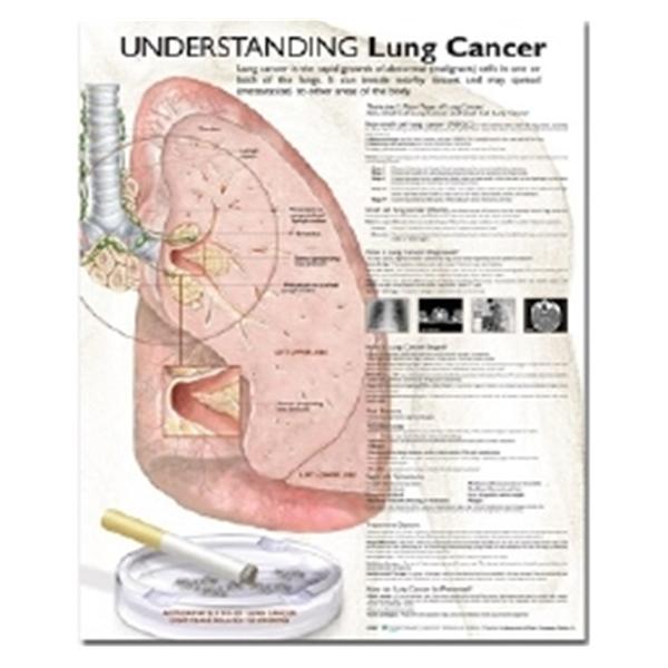 Understanding Lung Cancer 20x26" Anatomical Chart Ea