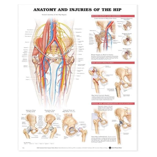 Anatomy & Injuries of the Hip 20x26" Anatomical Chart Ea