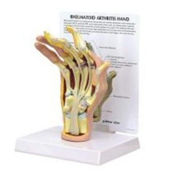 GPI Anatomicals Rheumatoid Arthritis Hand Model Ea