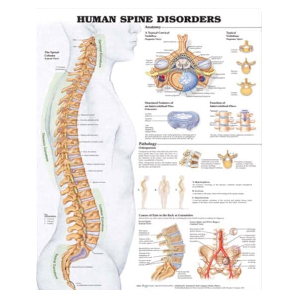 Spine Disorder 20x26" Clinical Chart Ea