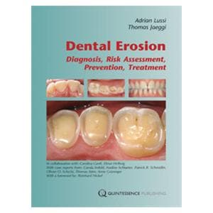 Book Dental Erosion: Diagnosis, Risk Assessment, Prevention, Treatment Ea