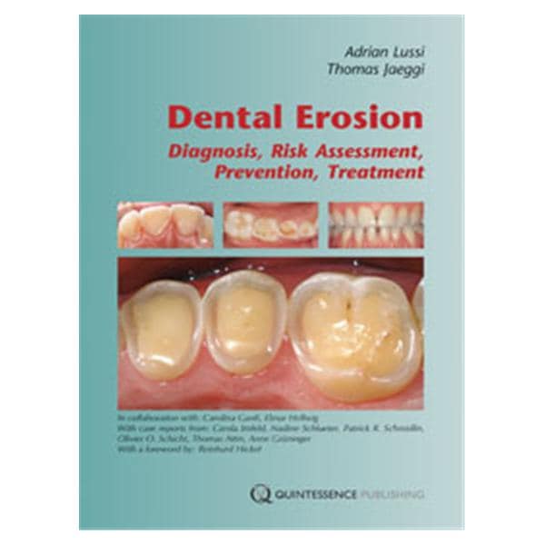 Book Dental Erosion: Diagnosis, Risk Assessment, Prevention, Treatment Ea