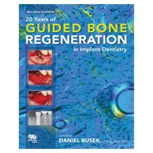 Book 20 Years of Guided Bone Regeneration in Implant Dentistry 2nd Edition Ea